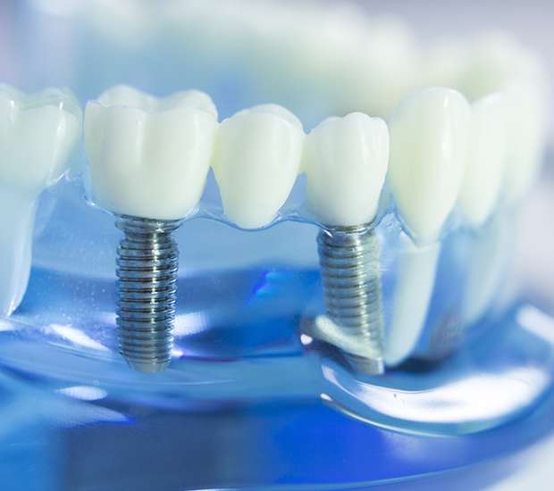 Peabody Dental Implants