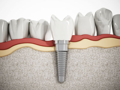 How Bone Loss Impacts Dental Implants