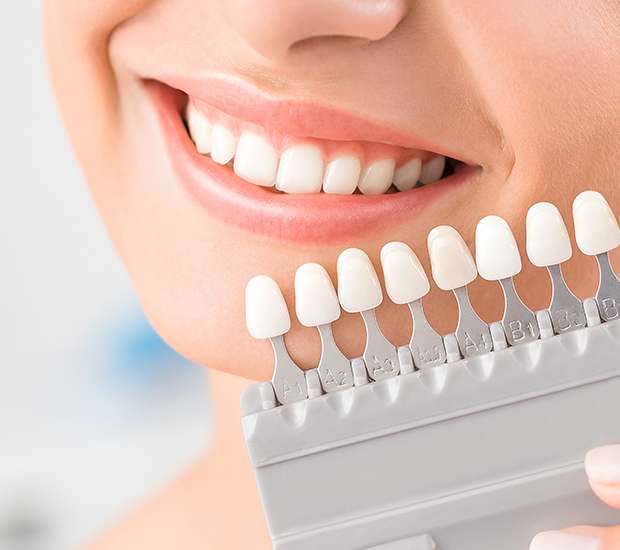 Peabody Dental Veneers and Dental Laminates